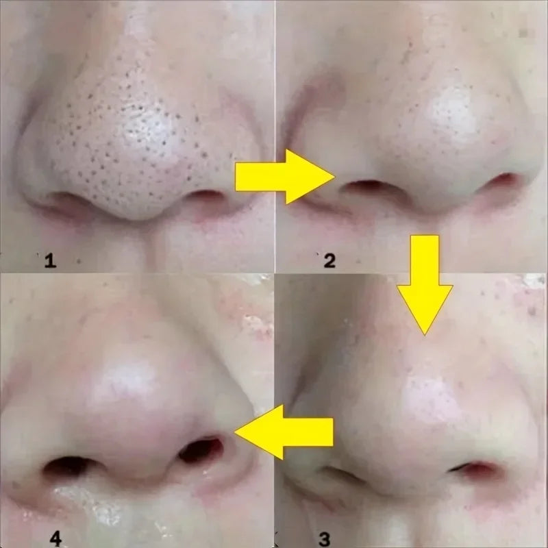 Collage of four images showing a close-up of a nose with yellow arrows pointing to different areas.