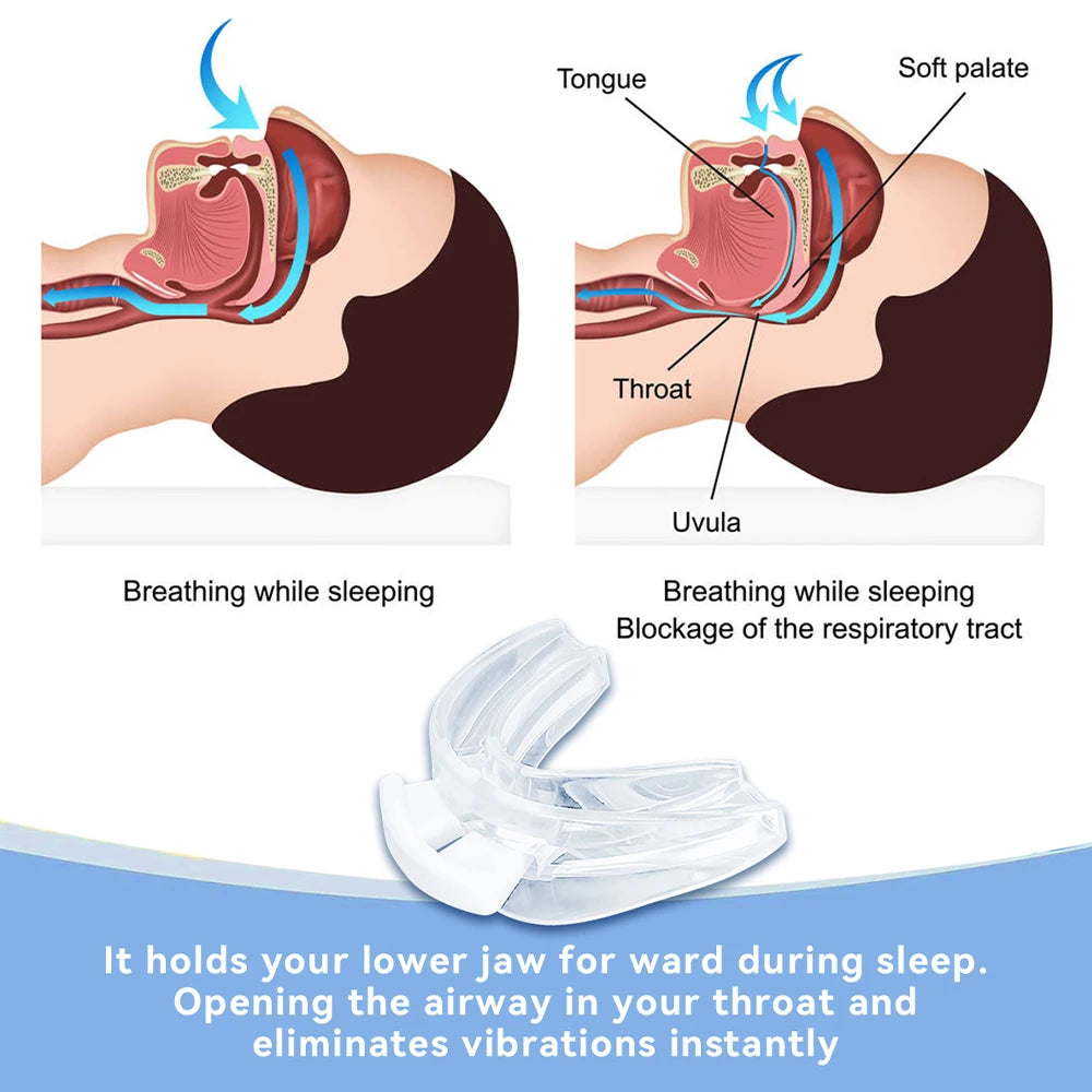 Silent Stratus - Adjustable Anti Snoring Mouth Guard